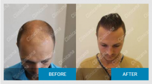 Clinicana Before After